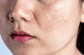 When will I see the results? Understanding healing, scabbing, scar prevention, and pigmentation changes Ellesmere Port
